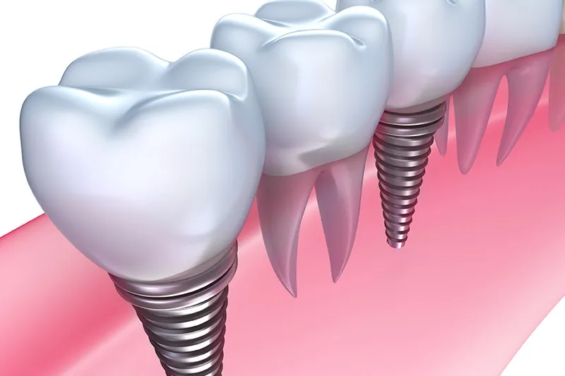 入れ歯とインプラントの比較