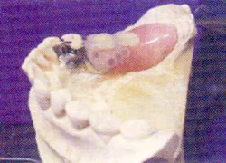 1）リプロデンチャー